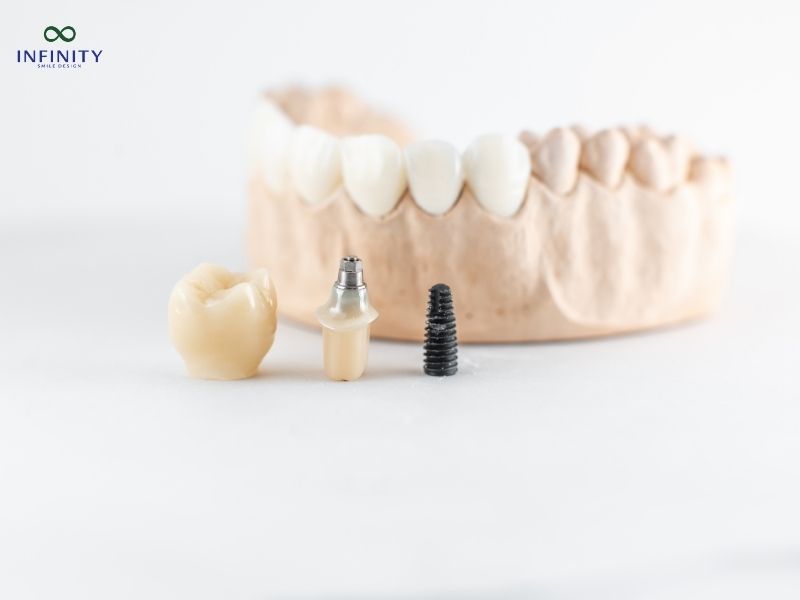 Các biến chứng sau khi cấy implant Các biến chứng sau khi cấy implant