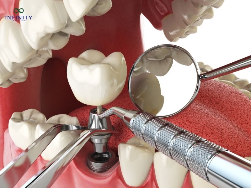 So sánh cầu răng và implant
