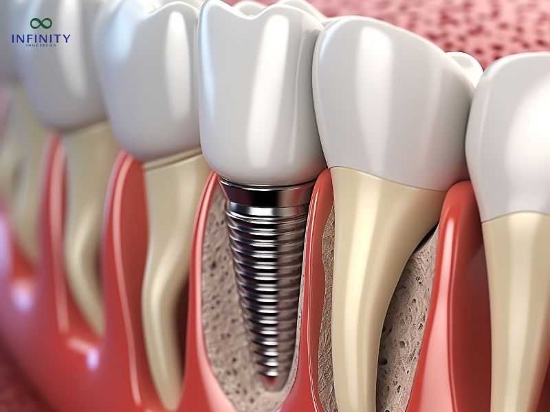 Cầu răng và implant là gì?