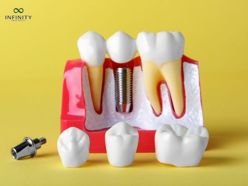 Các yếu tố ảnh hưởng đến chi phí trồng răng Implant một chiếc răng Các yếu tố ảnh hưởng đến chi phí trồng răng Implant một chiếc răng
