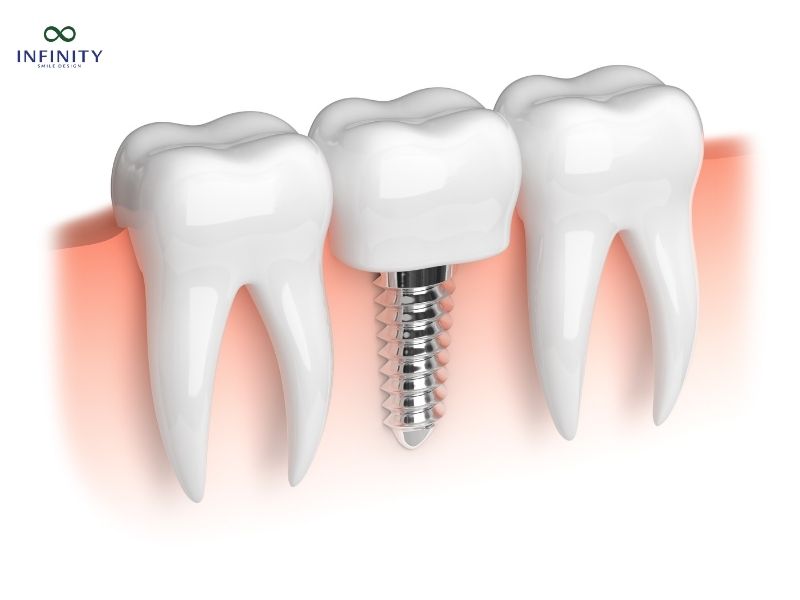 Trồng Răng Implant Mất Bao Lâu?