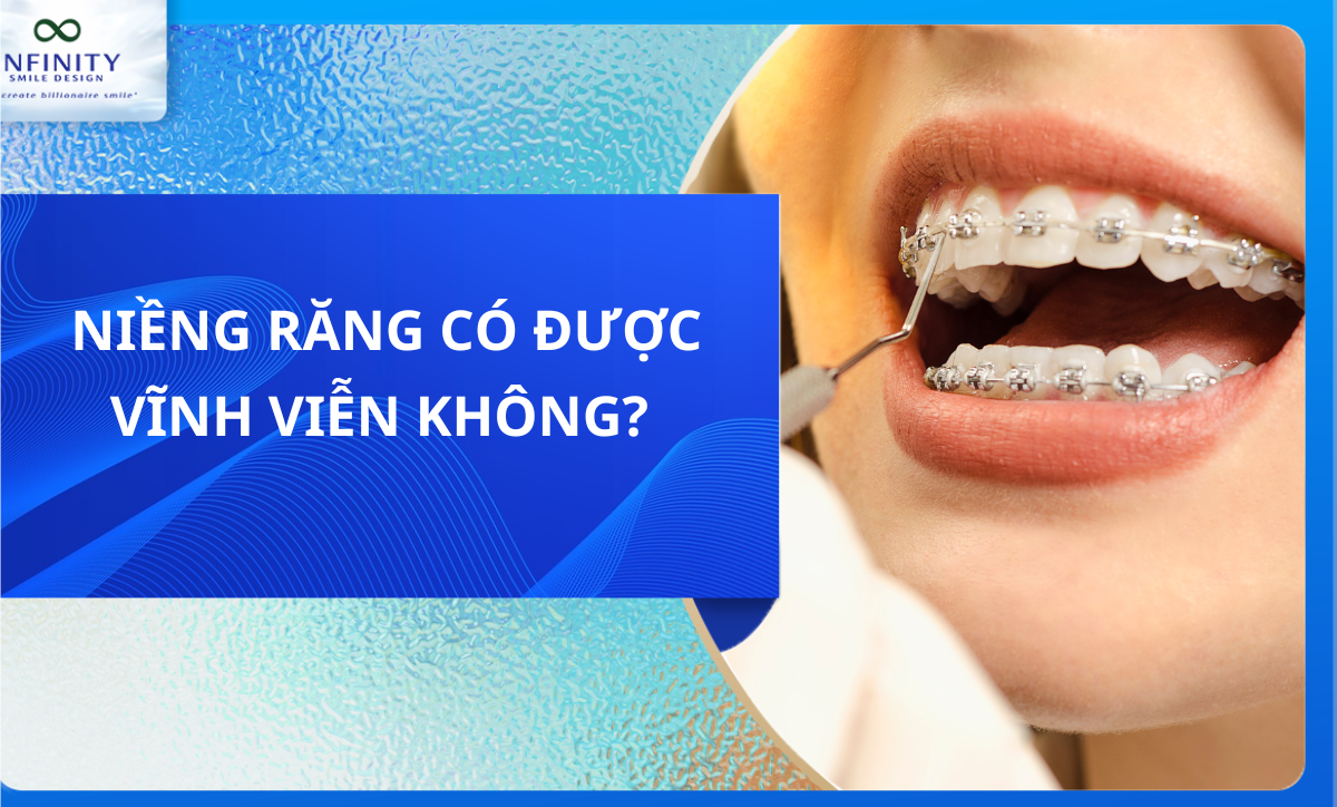 NIỀNG RĂNG CÓ ĐƯỢC VĨNH VIỄN KHÔNG?