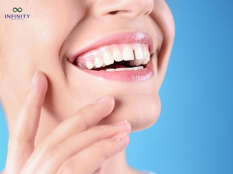 Tổng chi phí niềng răng thưa bao nhiêu tiền?