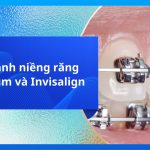 So sánh niềng răng Zenyum và Invisalign