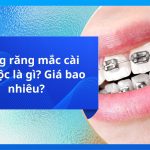 Niềng răng mắc cài tự buộc là gì? Giá bao nhiêu?