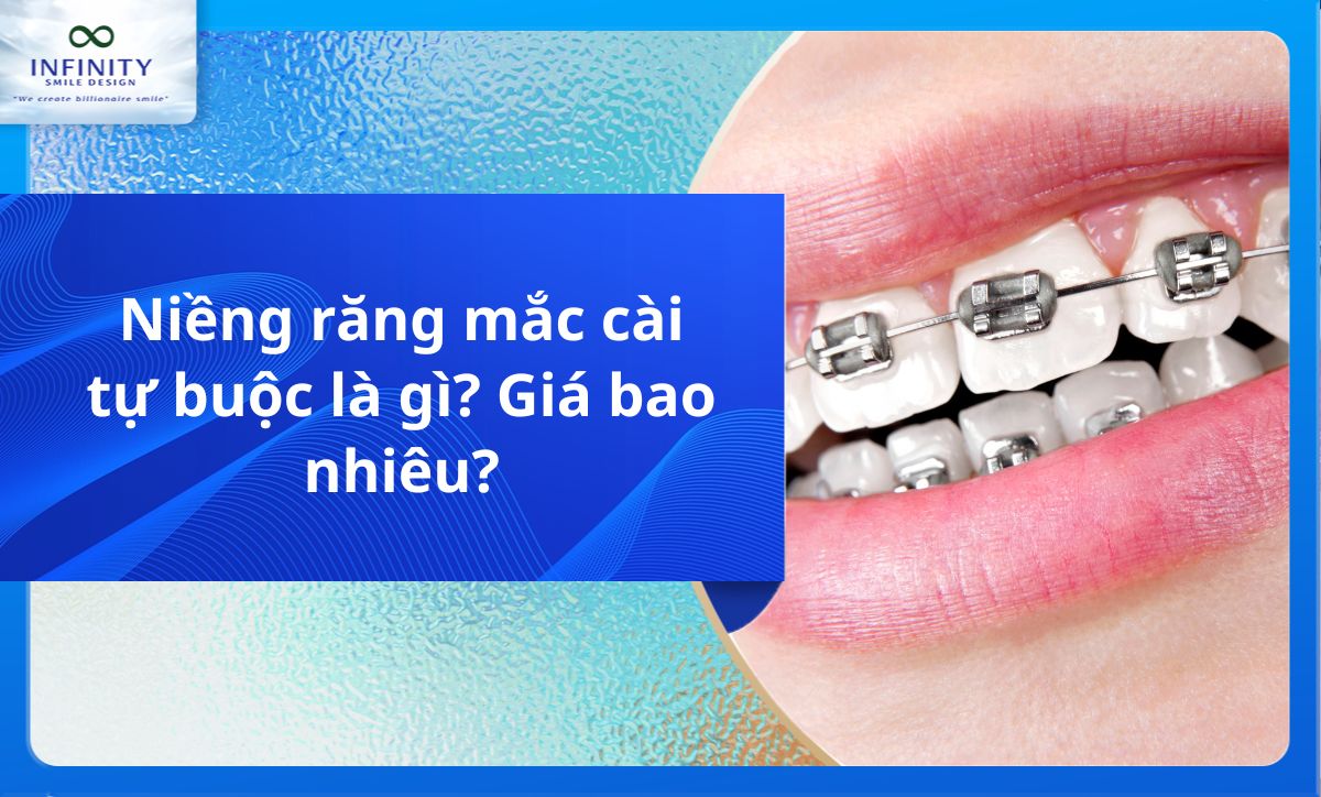Niềng răng mắc cài tự buộc là gì? Giá bao nhiêu?