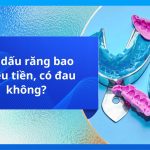 Lấy dấu răng bao nhiêu tiền, có đau không?