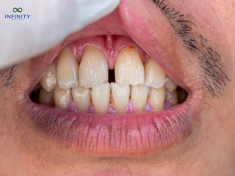 Lợi ích và rủi ro khi niềng răng thưa