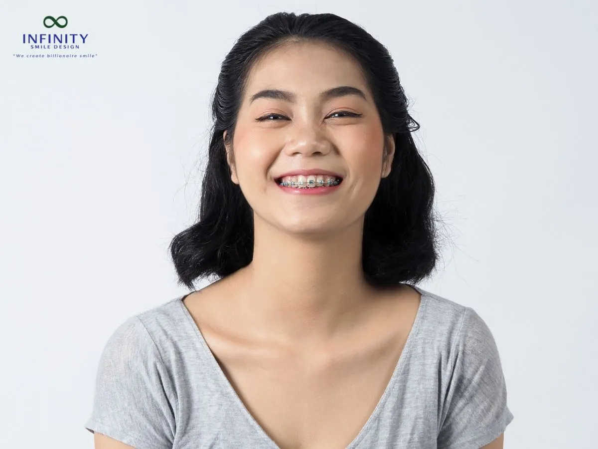 Lợi ích khi sử dụng thun tách kẽ đều đặn