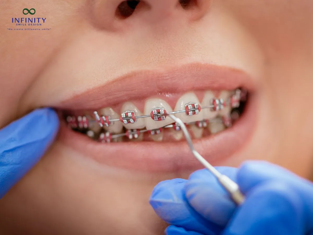 Những lưu ý và thắc mắc thường gặp về lò xo niềng răng