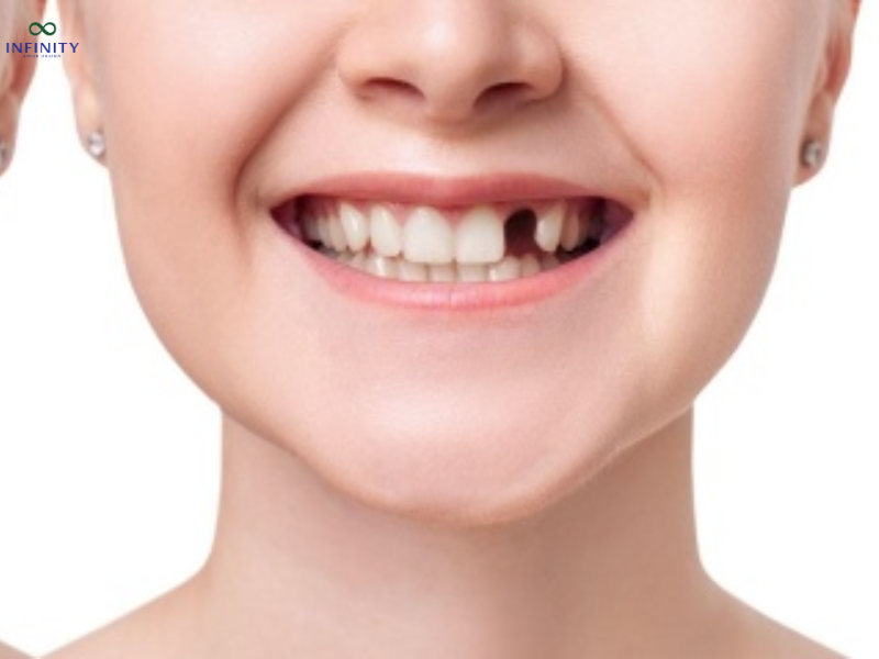 Răng số 2 tuy nhỏ, nhưng lại giữ vai trò quan trọng trong việc cân bằng thẩm mỹ và cấu trúc khớp cắn