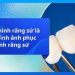 Phục hình răng sứ là gì? Hình ảnh phục hình răng sứ
