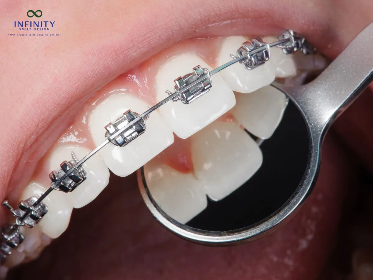 Lò xo niềng răng là một dụng cụ chuyên dụng trong chỉnh nha