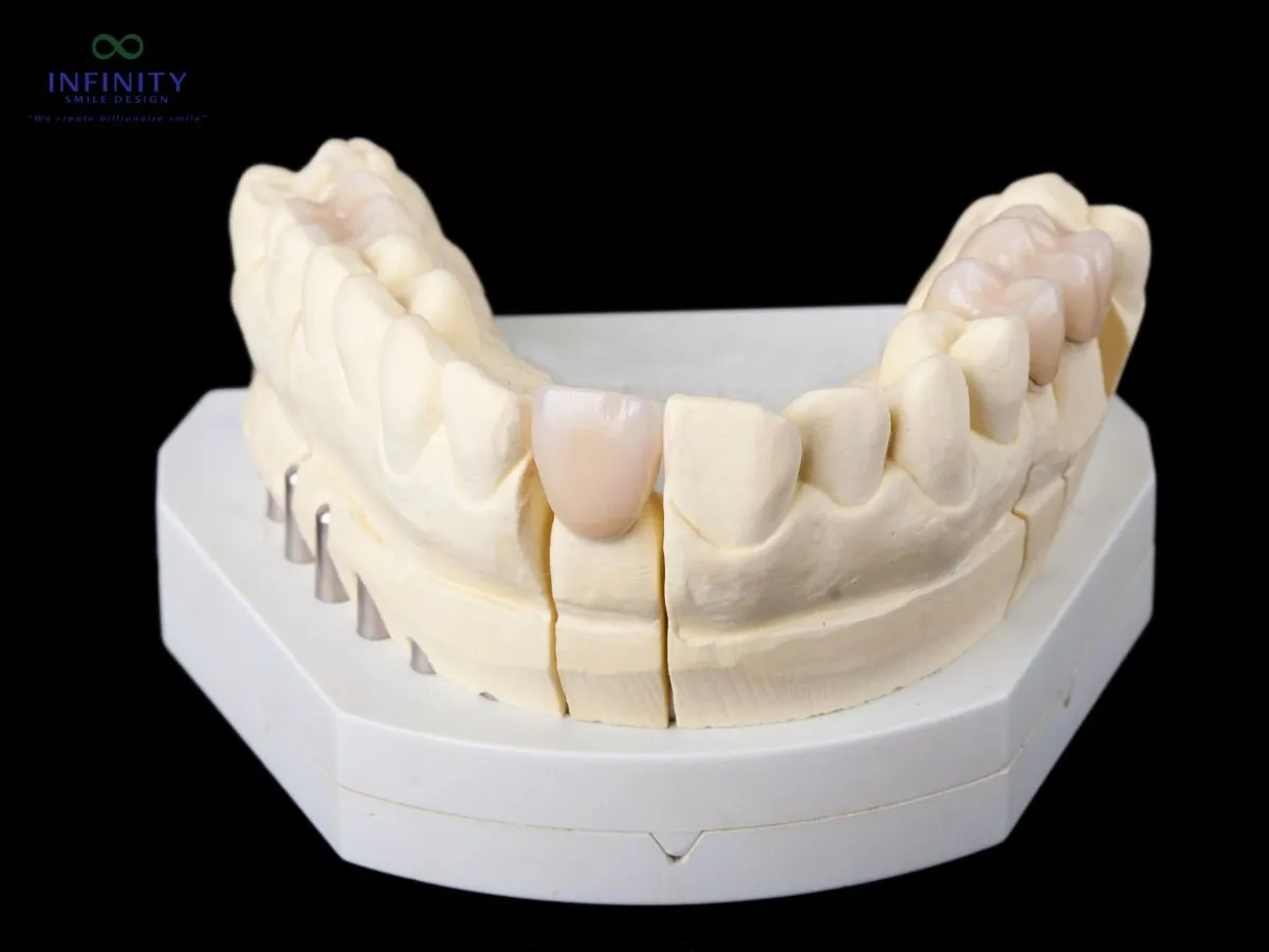 Sáp Nha Khoa Là Gì Và Tại Sao Nó Quan Trọng Trong Quá Trình Niềng Răng? 5 Các lưu ý khi chọn mua và sử dụng sáp nha khoa