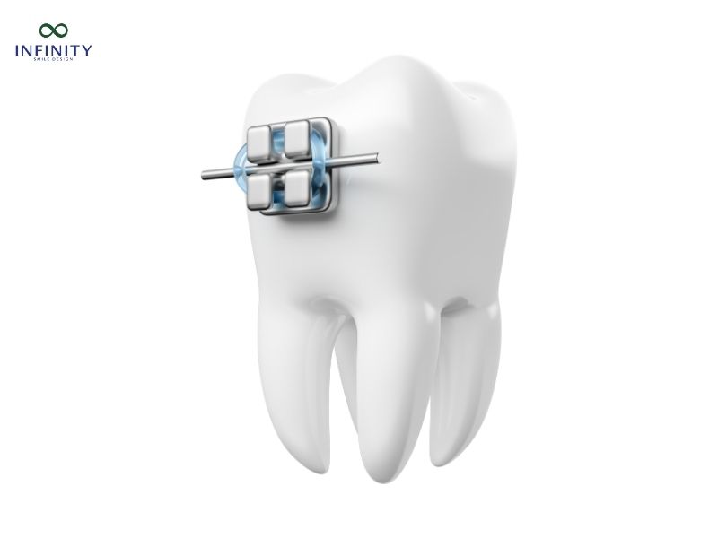 Niềng 1 răng giá bao nhiêu? Giá niềng mới nhất 2025
