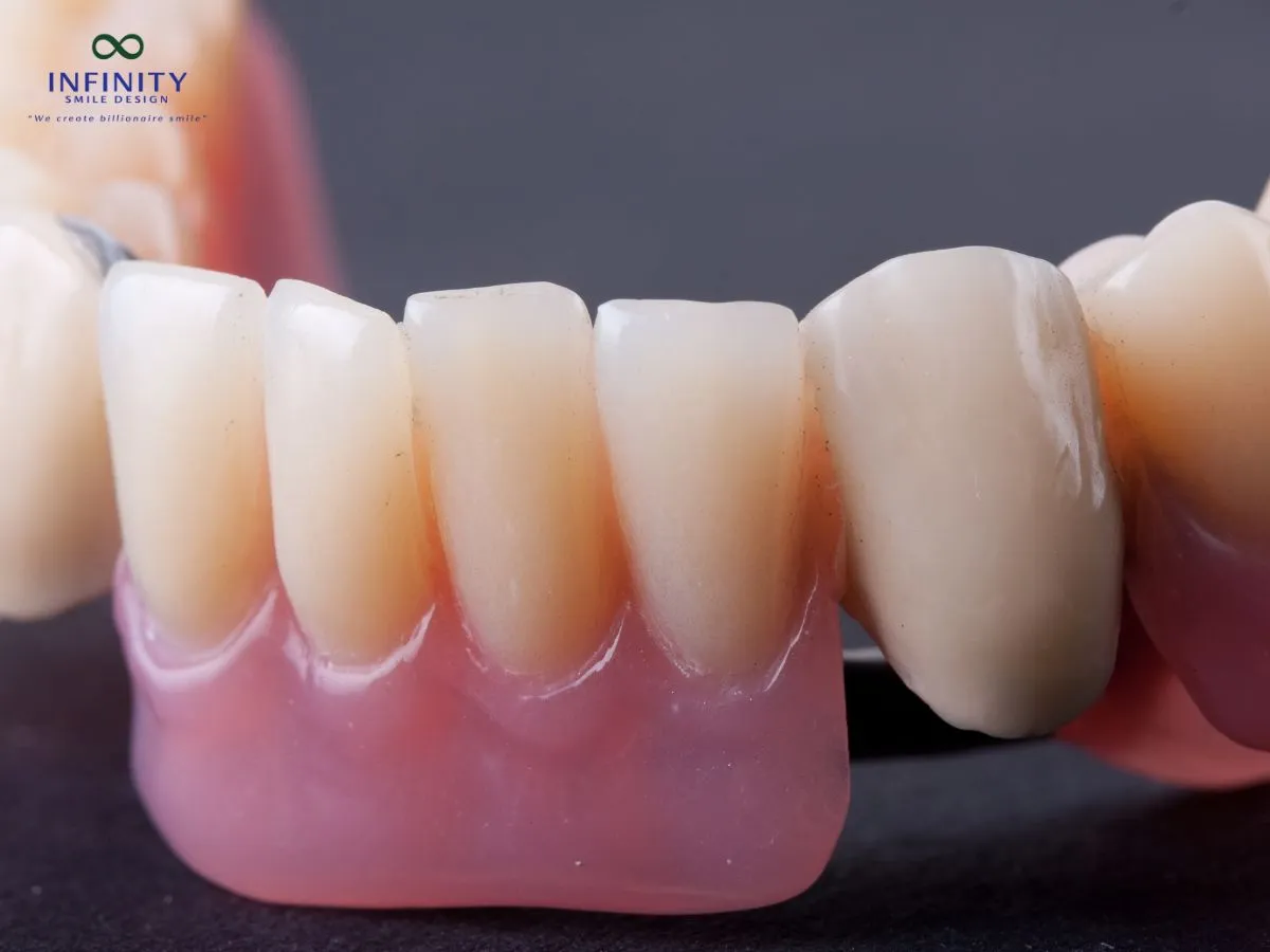 Sáp Nha Khoa Là Gì Và Tại Sao Nó Quan Trọng Trong Quá Trình Niềng Răng? 4 Lợi ích nổi bật của sáp nha khoa trong quá trình niềng răng