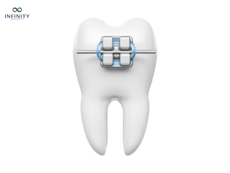 Thời gian niềng 1 răng mất bao lâu?