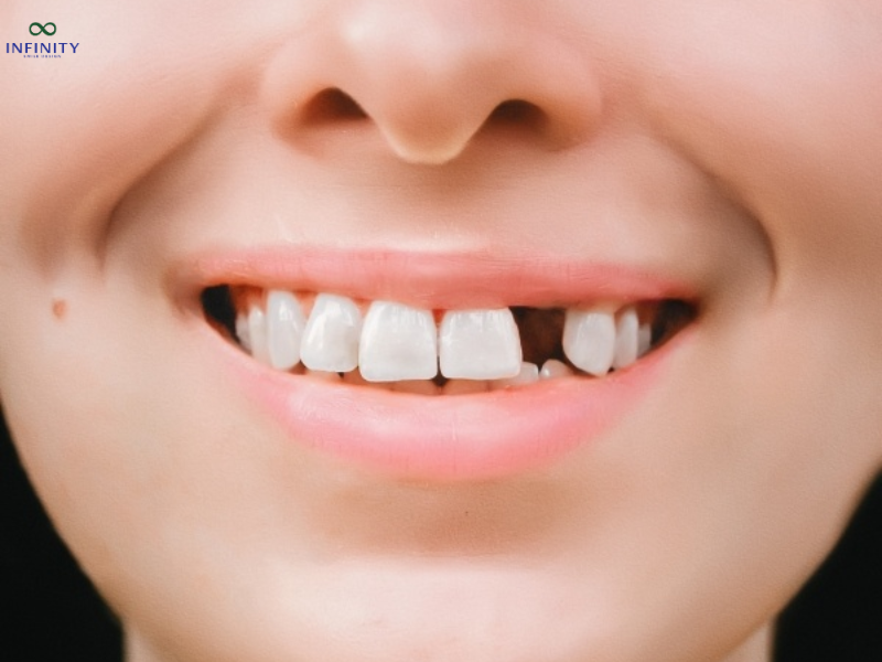 Răng số 2, hay còn gọi là răng cửa bên