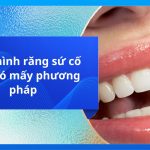 Phục hình răng sứ cố định có mấy phương pháp