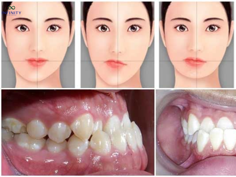 Niềng răng bị lệch mặt, nhân trung