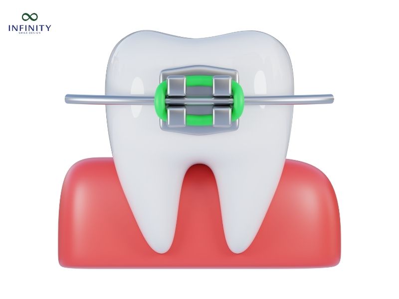 Niềng 1 răng là gì và tại sao cần niềng?