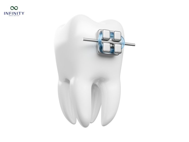 Báo giá niềng 1 răng mới nhất 2025 tại Nha Khoa Infinity