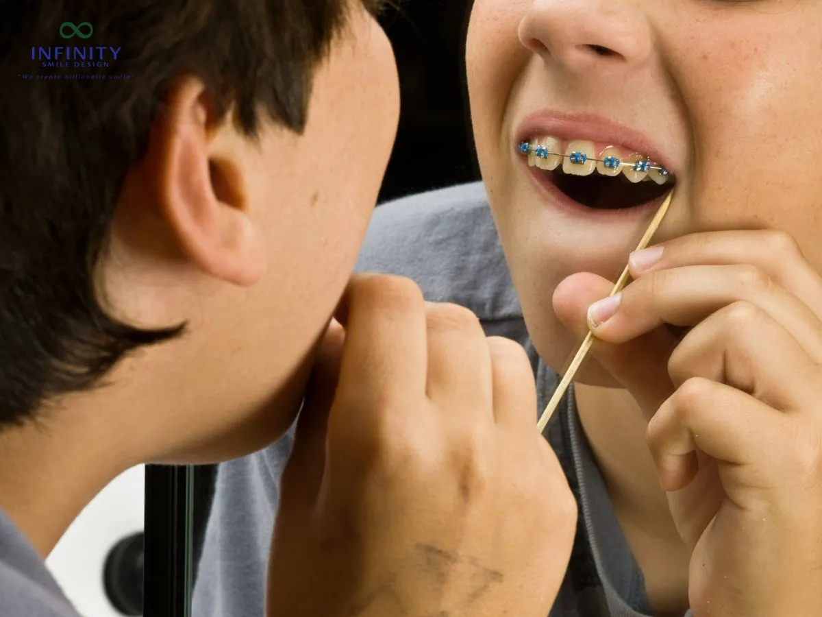 Hướng Dẫn Quy Trình Tháo Niềng Răng Chi Tiết Và Đầy Đủ Nhất 5 Lời khuyên và lưu ý sau khi thực hiện quy trình tháo niềng răng.