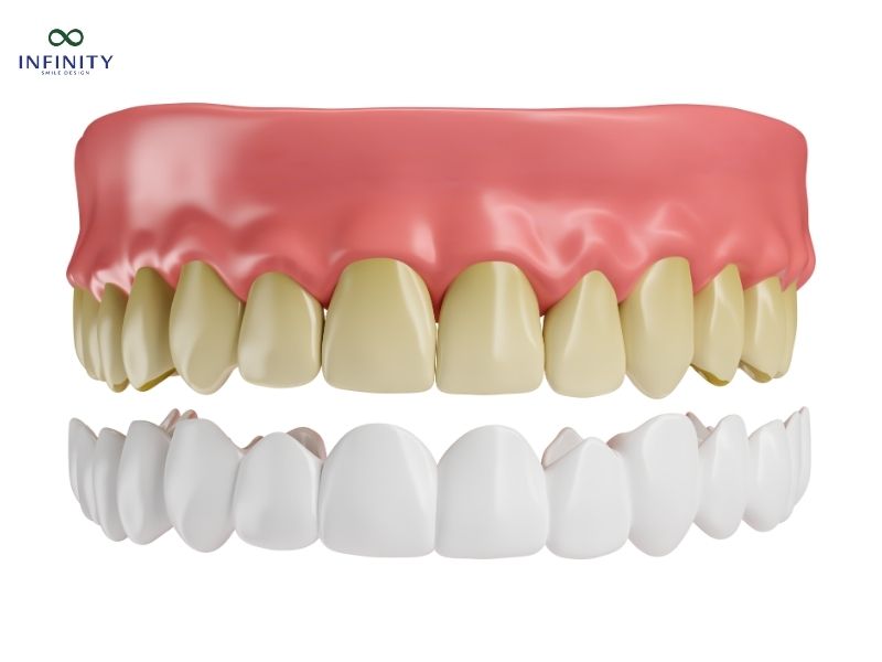Phục hình răng sứ cố định có mấy phương pháp? Phục hình răng sứ cố định có mấy phương pháp?