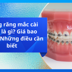 Niềng răng mắc cài titan là gì? Giá bao nhiêu? Những điều cần biết