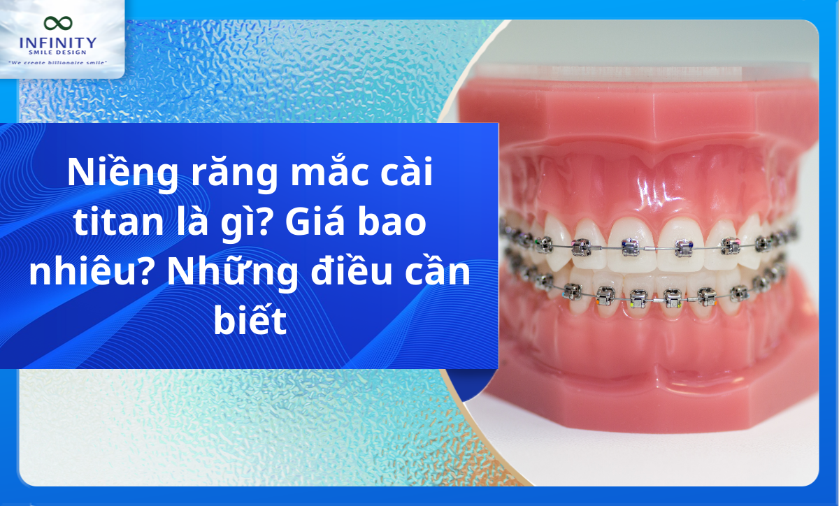 Niềng răng mắc cài titan là gì? Giá bao nhiêu? Những điều cần biết