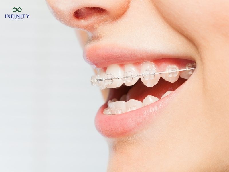 Tình trạng răng thưa và ảnh hưởng của nó