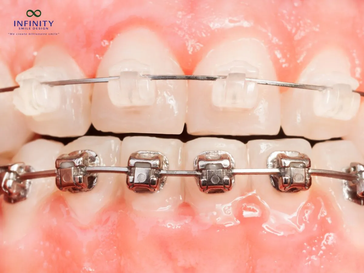 Quy trình thực hiện nâng khớp cắn