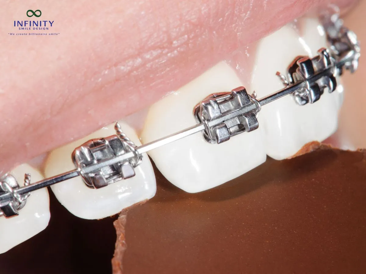 Các phương pháp nâng khớp cắn phổ biến hiện nay