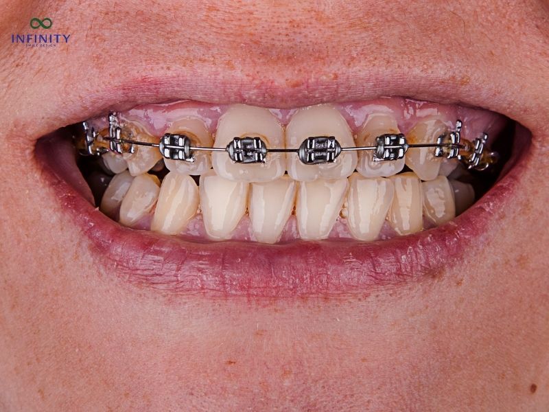 Niềng răng mắc cài titan giá bao nhiêu?