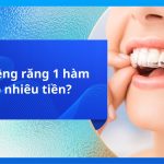 Giá niềng răng 1 hàm bao nhiêu tiền?