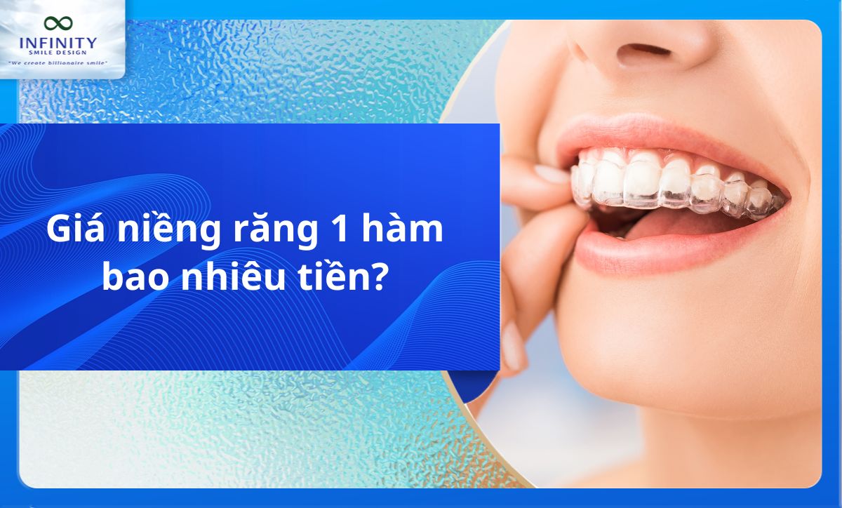 Giá niềng răng 1 hàm bao nhiêu tiền?