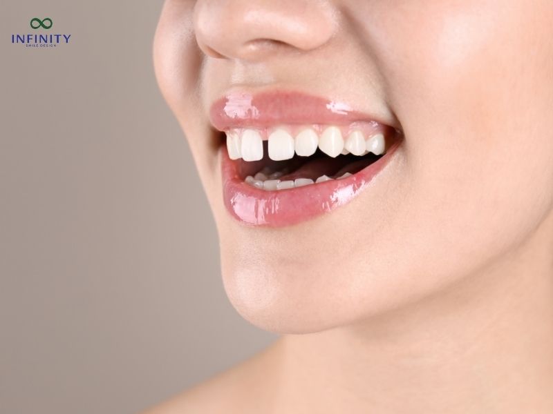Tổng chi phí niềng răng thưa bao nhiêu tiền?