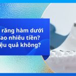 Niềng răng hàm dưới giá bao nhiêu tiền? Có hiệu quả không?
