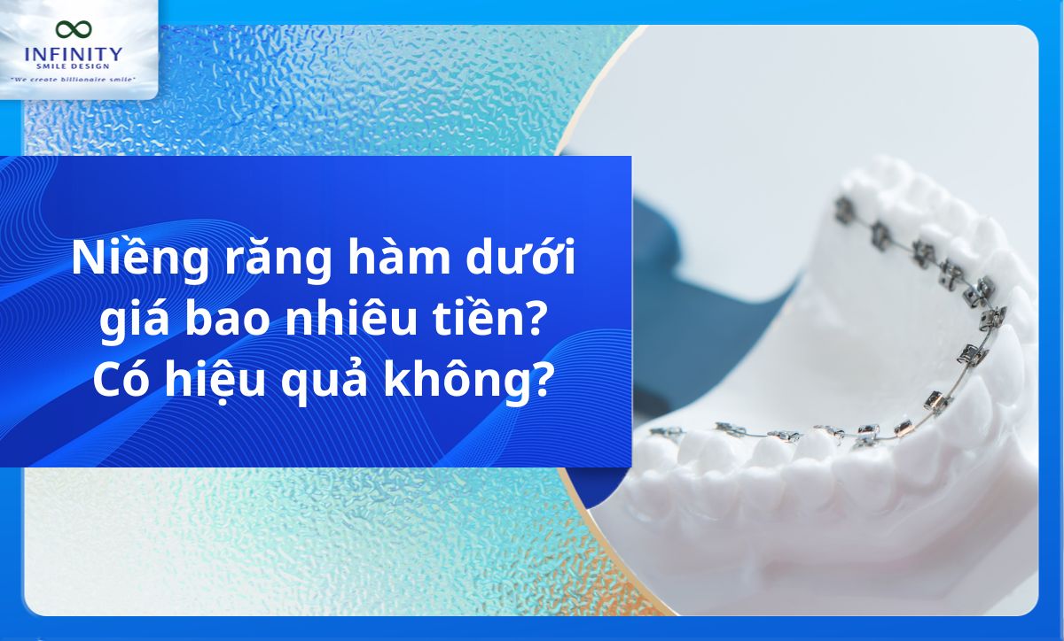 Niềng răng hàm dưới giá bao nhiêu tiền? Có hiệu quả không?