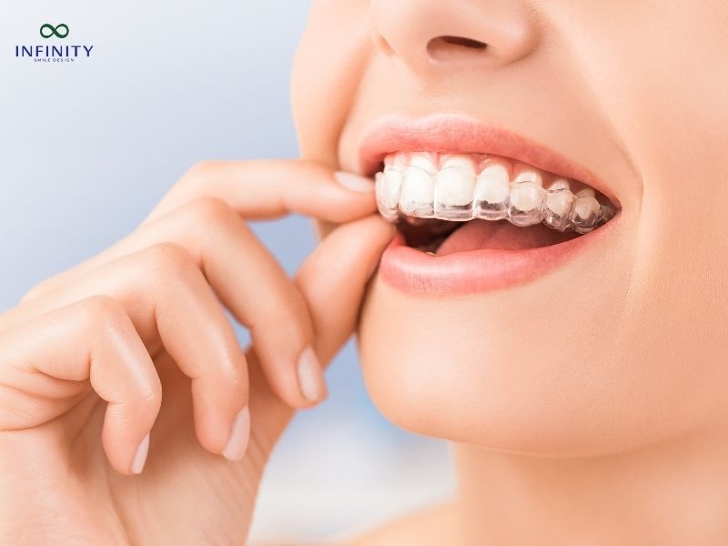 Các loại hình niềng răng phổ biến và chi phí tương ứng cho 1 hàm Các loại hình niềng răng phổ biến và chi phí tương ứng cho 1 hàm