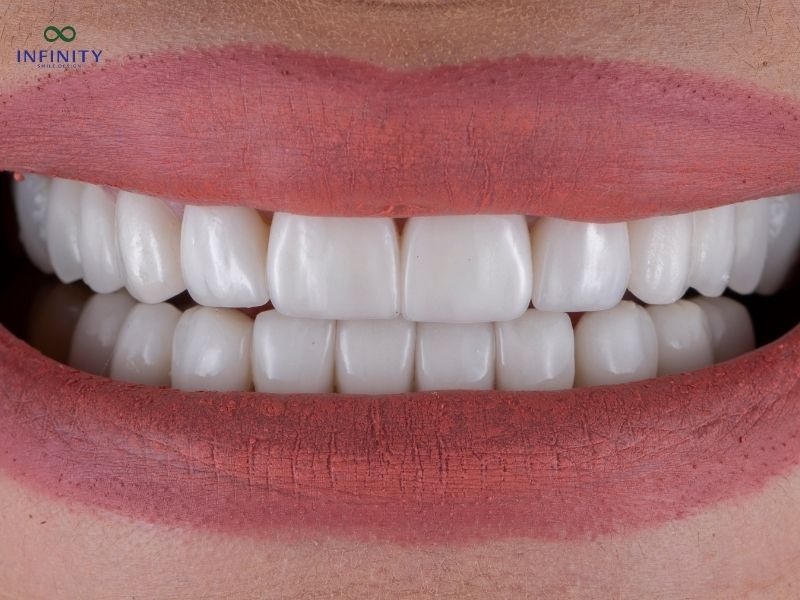 Các yếu tố ảnh hưởng đến chất lượng và hình ảnh phục hình răng sứ Các yếu tố ảnh hưởng đến chất lượng và hình ảnh phục hình răng sứ