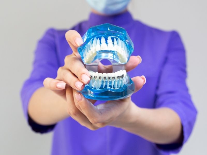 Niềng răng hàm dưới giá bao nhiêu tiền?