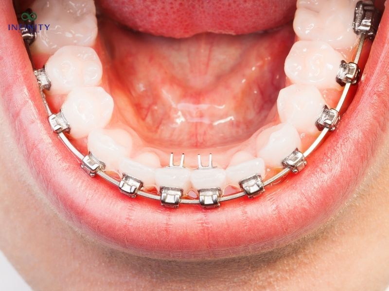 Niềng răng hàm dưới giá bao nhiêu