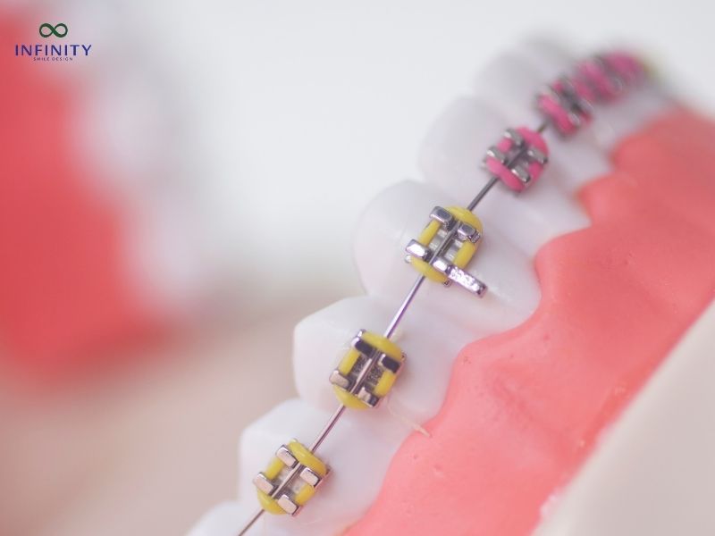 Niềng răng hàm dưới giá bao nhiêu