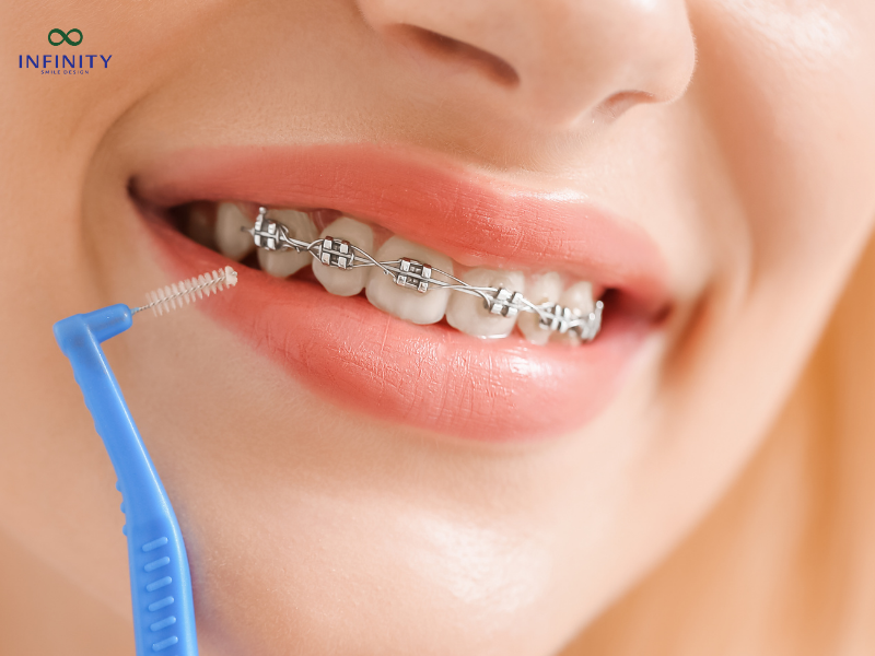 Quy trình niềng răng mắc cài titan