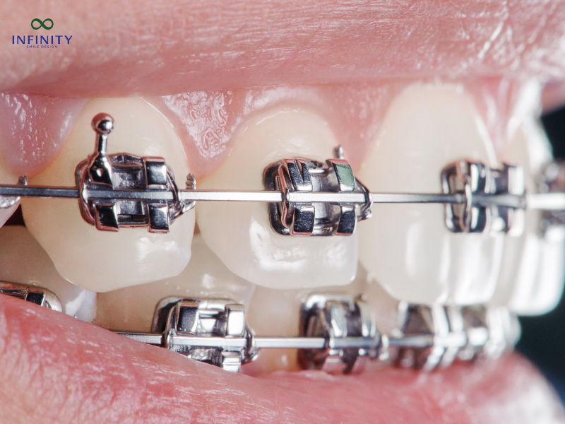 Niềng răng mắc cài titan là gì?