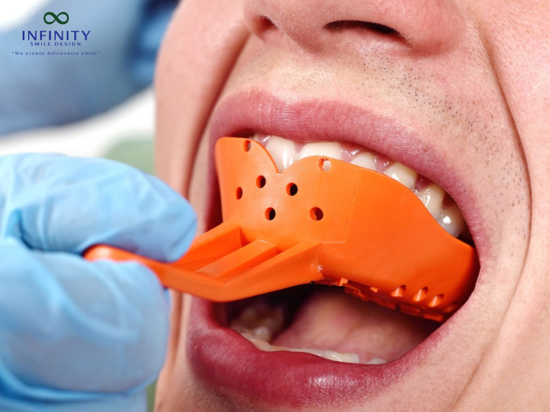 Các phương pháp lấy dấu răng hiện nay