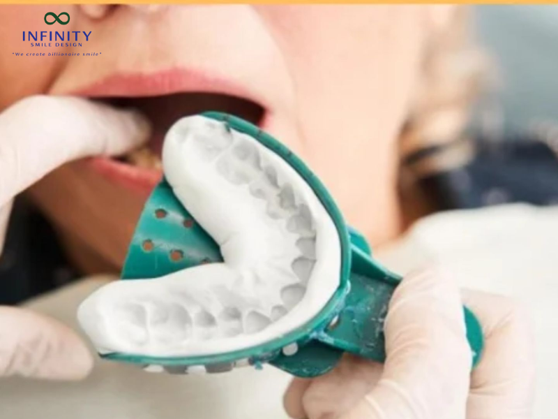 Lấy dấu răng là gì?