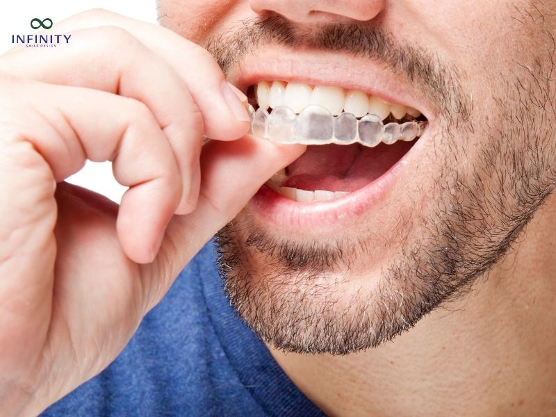 Nên chọn niềng răng Zenyum hay Invisalign?