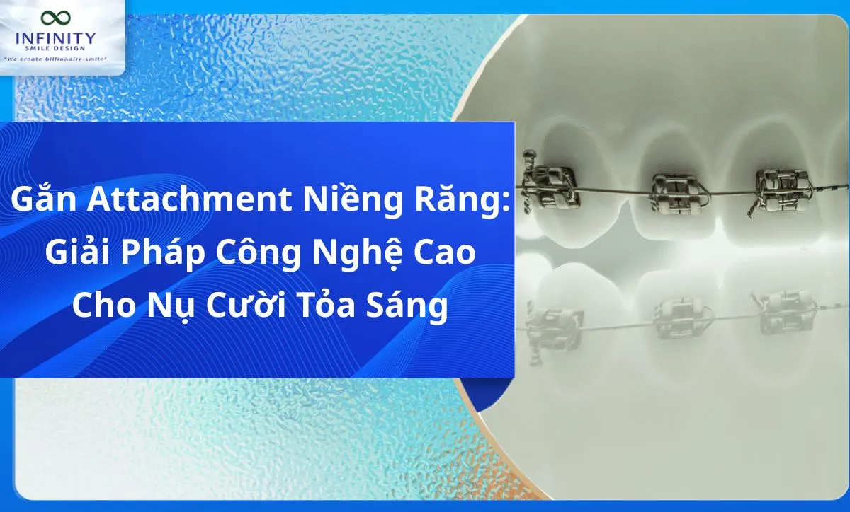 Gắn Attachment Niềng Răng: Giải Pháp Công Nghệ Cao Cho Nụ Cười Tỏa Sáng